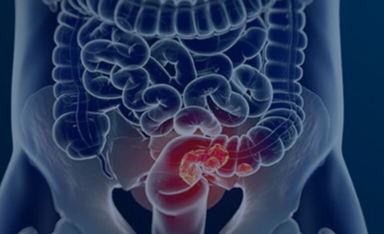 Pacientes com câncer colorretal são diagnosticados em estágio avançado